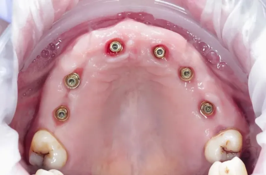 Multi-unit Abutment Nedir?